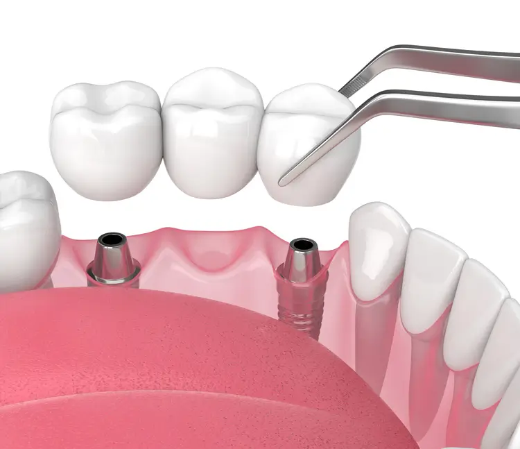3D-Darstellung einer implantatgetragenen Br&uuml;cke im Unterkiefer