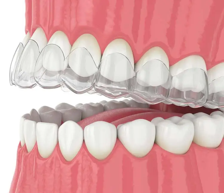 3D-Darstellung einer transparenten Invisalign-Schiene, die passgenau über die Zähne gesetzt wird