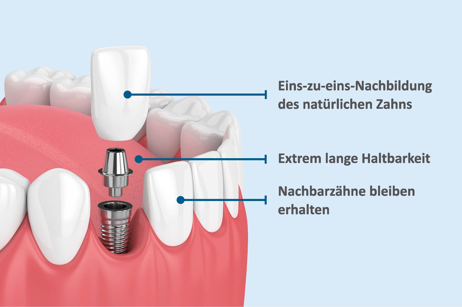 Zahnimplantat Darstellung AllDent 