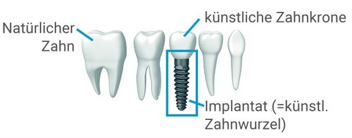 Zeichnung Zahnimplantat mit Krone, links und rechts jeweils zwei natürliche Zähne