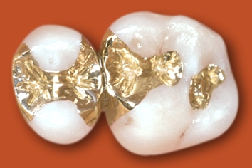 Gold Inlay AllDent